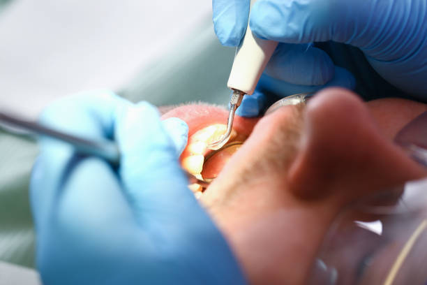Best Emergency Dental Extractions in Griffith, IN