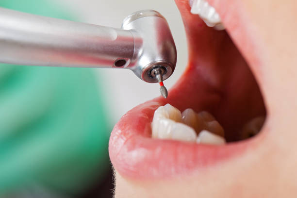 Best Emergency Dentist for Lost Fillings or Crowns in Griffith, IN
